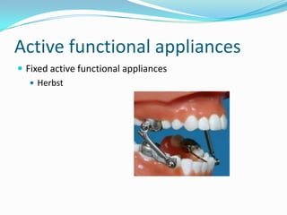 Active functional appliances
 Fixed active functional appliances
    Herbst
 
