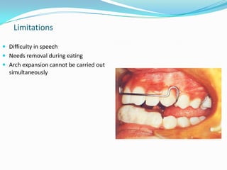 Limitations

 Difficulty in speech
 Needs removal during eating
 Arch expansion cannot be carried out
  simultaneously
 