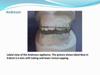 Andresen




Labial view of the Andresen appliance. The picture shows labial Bow in
0.8mm S.S wire with tubing and lower incisal capping.
 