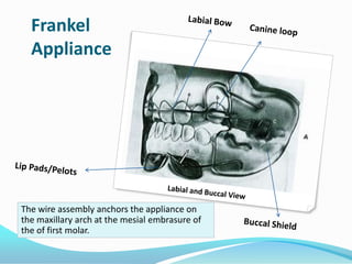 Frankel
  Appliance




The wire assembly anchors the appliance on
the maxillary arch at the mesial embrasure of
the of first molar.
 