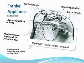 Frankel
Appliance
Rolf Frankel




A cross palatal
stabilizing wire on the
maxillary arch.
 