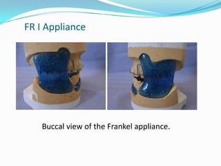 FR I Appliance




    Buccal view of the Frankel appliance.
 