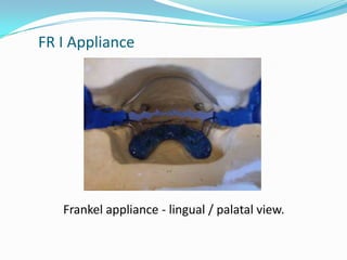 FR I Appliance




   Frankel appliance - lingual / palatal view.
 