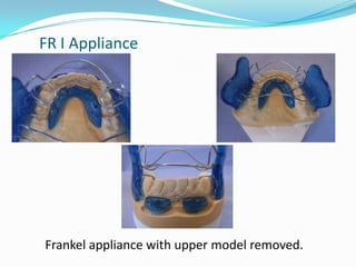 FR I Appliance




Frankel appliance with upper model removed.
 