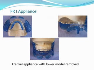 FR I Appliance




Frankel appliance with lower model removed.
 
