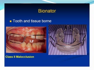 Bionator
 1.Light Appliance
 2.Better Compliance
 3.Full Time Wear


Timing for Bionator Therapy
 Effective and stable when it is initiated immediately before the pubertal growth
  spurt. Optimal timing to start treatment with the Bionator is when a concavity is
  evident at the lower borders of both the second and the third cervical vertebrae
  (CVMS II).

 In the long term, the amount of significant supplementary elongation of the
  mandible in subjects treated with the Bionator during the pubertal growth spurt
  is 5.1 mm more than that in untreated subjects with class-II malocclusion.
  Significant increments in mandibular ramus height and for a significantly more
  backward direction of condylar growth.
 