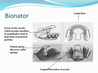 Labial Bow
Bionator
Facets in the acrylic
which accepts maxillary
& mandibular teeth &
hold them in postured
position

     Palatal spring
     (Reverse coffin
     spring)




                          Lingual horseshoe of acrylic
 