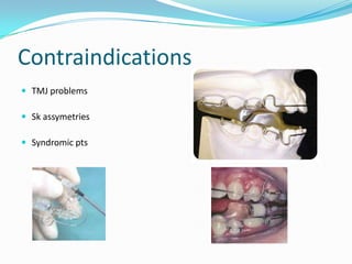 Contraindications
 TMJ problems

 Sk assymetries

 Syndromic pts
 