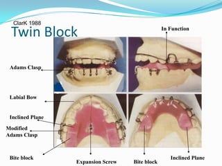 ClarK 1988

 Twin Block                                      In Function




 Adams Clasp




 Labial Bow


 Inclined Plane

Modified
Adams Clasp



 Bite block                                         Inclined Plane
                  Expansion Screw   Bite block
 