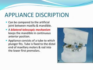 APPLIANCE DISCRIPTION
 Can be compared to the artificial
  joint between maxilla & mandible.
 A bilateral telescopic mechanism
  keeps the mandible in continuous
  anterior position.
 Appliance consists of a tube to which
  plunger fits. Tube is fixed to the distal
  end of maxillary molars & rod into
  the lower first premolars.
 