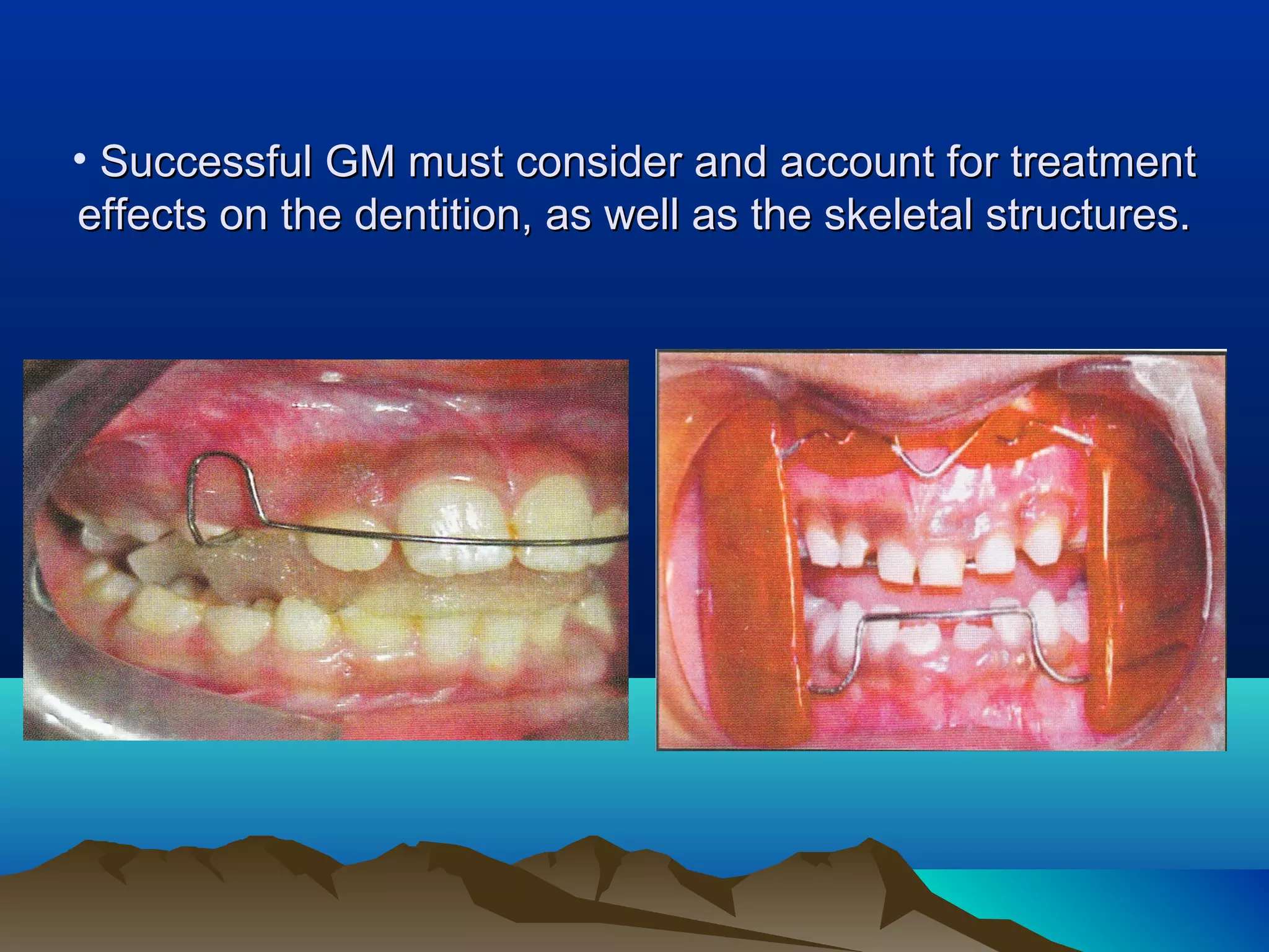 • Successful GM must consider and account for treatmentSuccessful GM must consider and account for treatment
effects on the dentition, as well as the skeletal structures.effects on the dentition, as well as the skeletal structures.
 
