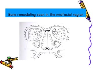 Bone remodeling seen in the midfacial region
 