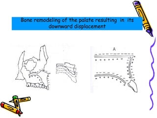 Bone remodeling of the palate resulting in its
downward displacement
 