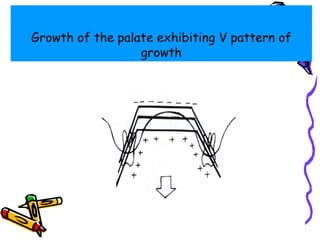 Growth of the palate exhibiting V pattern of
growth
 