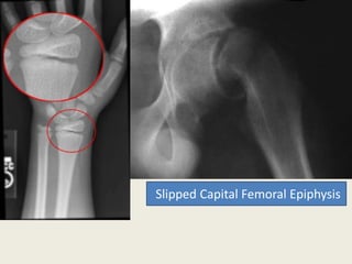 Slipped Capital Femoral Epiphysis
 