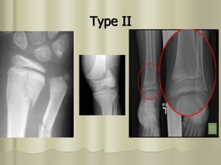 Type II
 