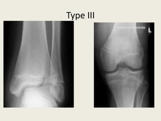 Type III
 