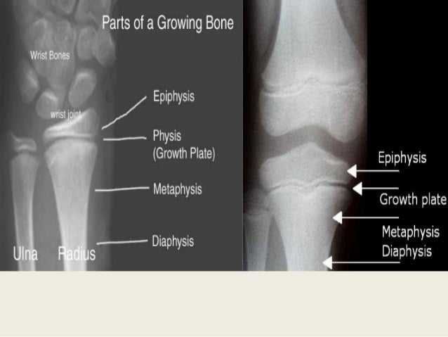 Growth Plate Injury growth-plate-injury