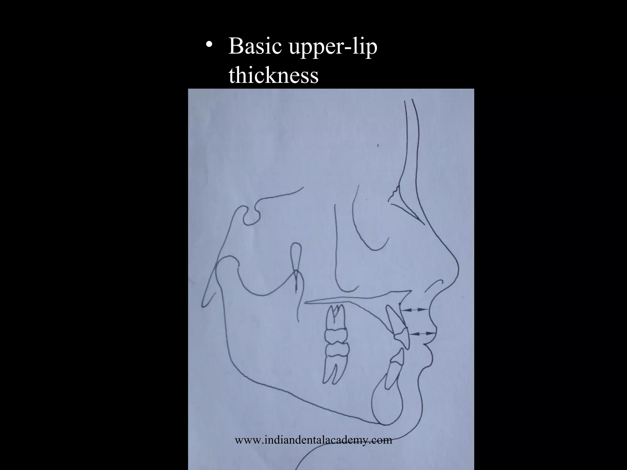 • Basic upper-lip
thickness
www.indiandentalacademy.com
 