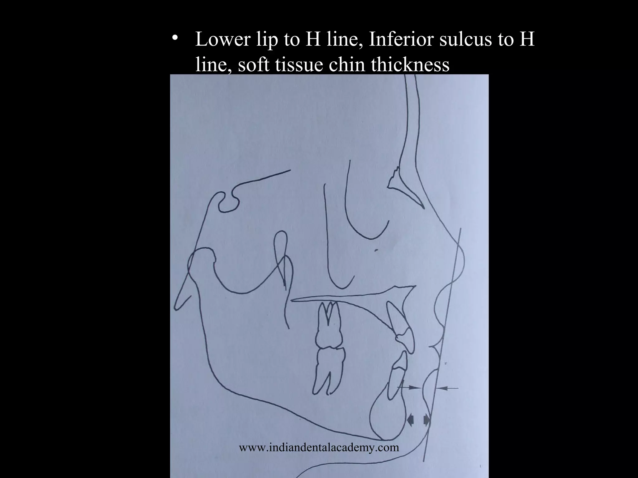 • Lower lip to H line, Inferior sulcus to H
line, soft tissue chin thickness
www.indiandentalacademy.com
 