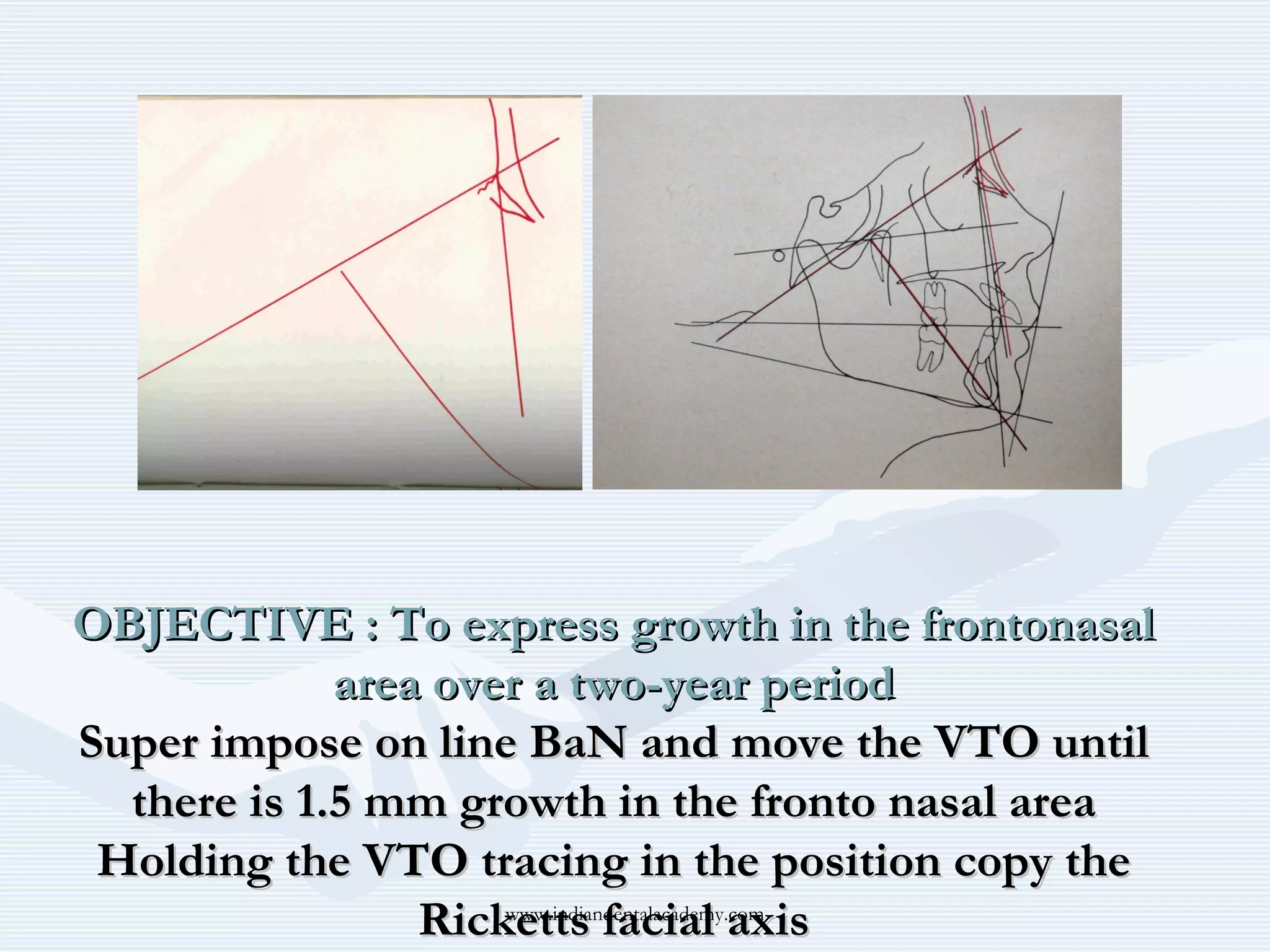 OBJECTIVE : To express growth in the frontonasal
area over a two-year period
Super impose on line BaN and move the VTO until
there is 1.5 mm growth in the fronto nasal area
Holding the VTO tracing in the position copy the
www.indiandentalacademy.com
Ricketts facial axis

 