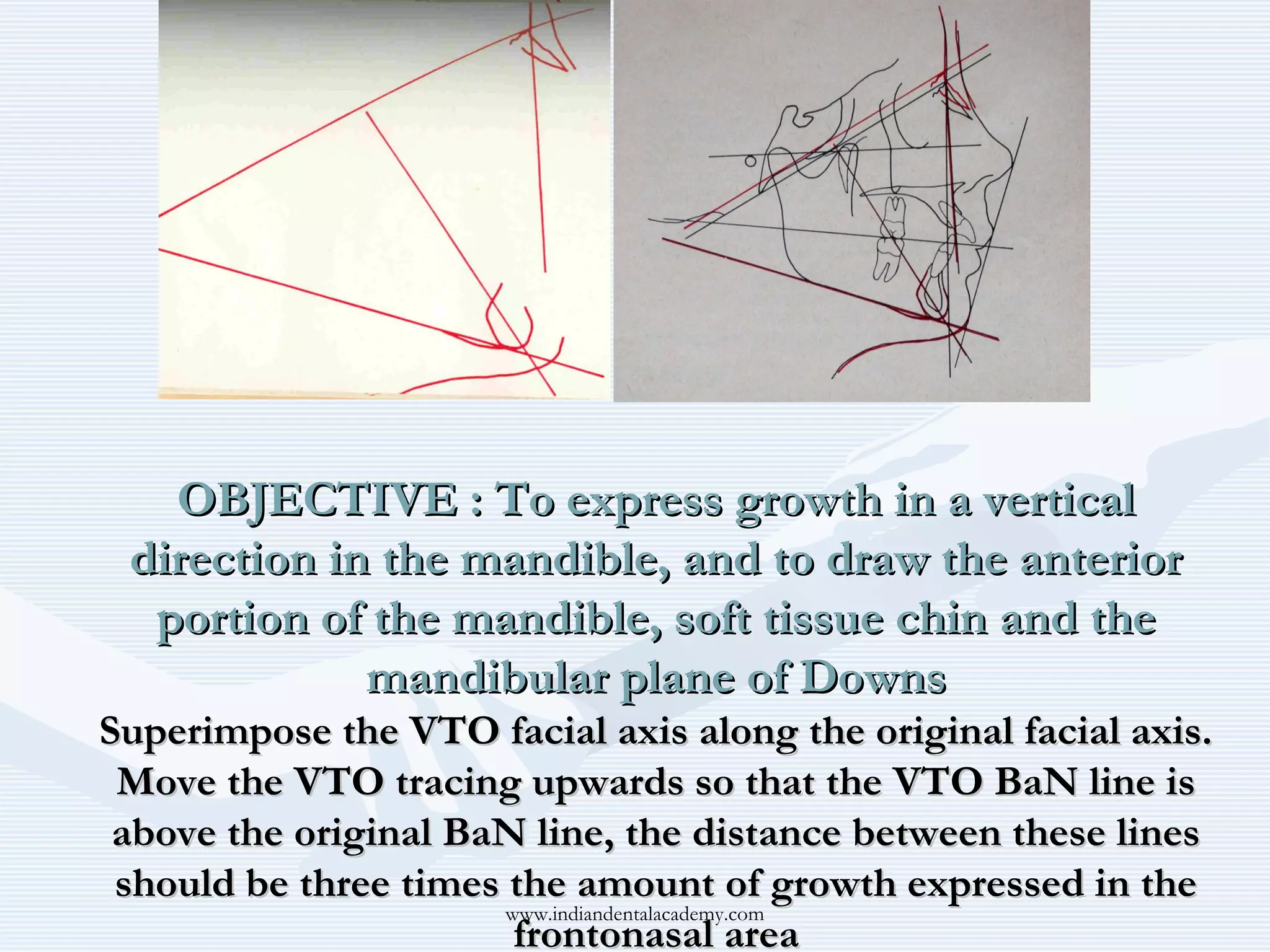 OBJECTIVE : To express growth in a vertical
direction in the mandible, and to draw the anterior
portion of the mandible, soft tissue chin and the
mandibular plane of Downs
Superimpose the VTO facial axis along the original facial axis.
Move the VTO tracing upwards so that the VTO BaN line is
above the original BaN line, the distance between these lines
should be three times the amount of growth expressed in the
www.indiandentalacademy.com
frontonasal area

 