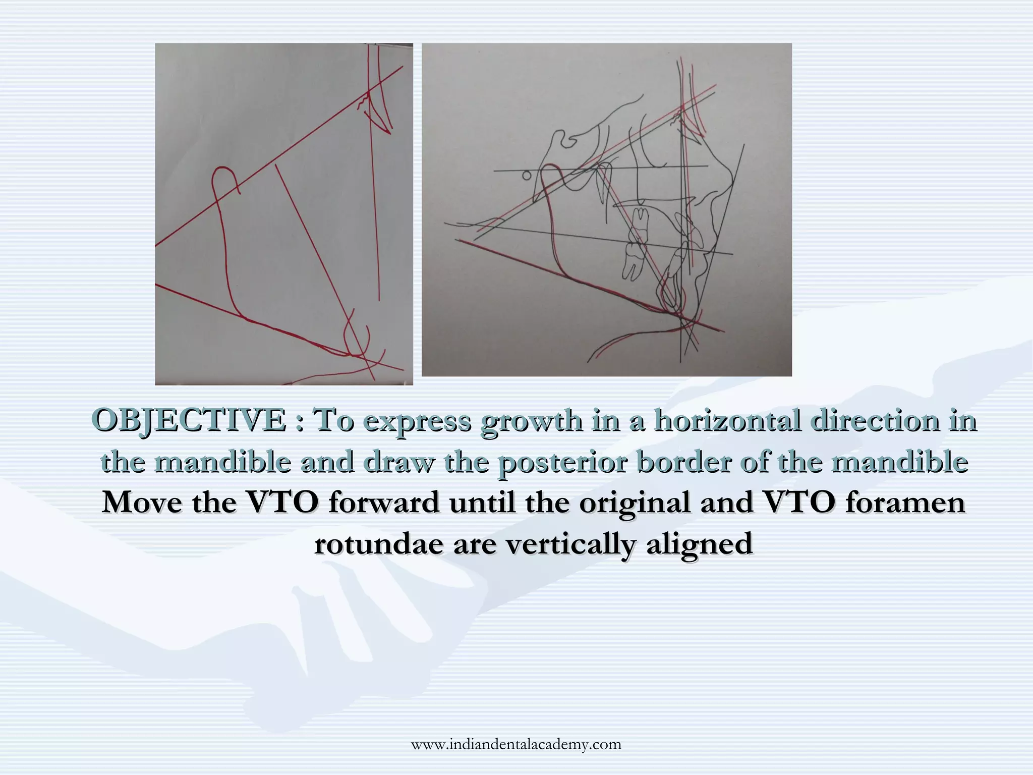 OBJECTIVE : To express growth in a horizontal direction in
the mandible and draw the posterior border of the mandible
Move the VTO forward until the original and VTO foramen
rotundae are vertically aligned

www.indiandentalacademy.com

 