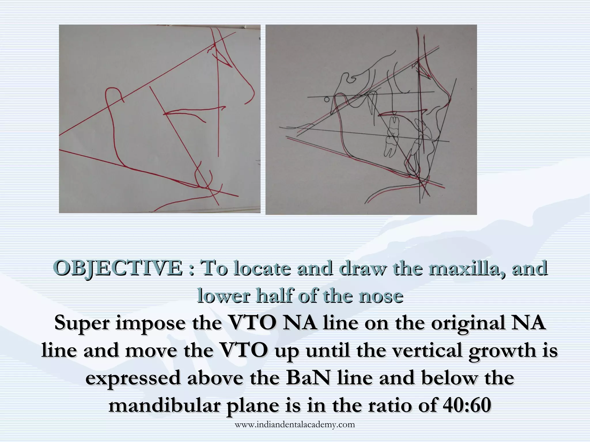 OBJECTIVE : To locate and draw the maxilla, and
lower half of the nose
Super impose the VTO NA line on the original NA
line and move the VTO up until the vertical growth is
expressed above the BaN line and below the
mandibular plane is in the ratio of 40:60
www.indiandentalacademy.com

 