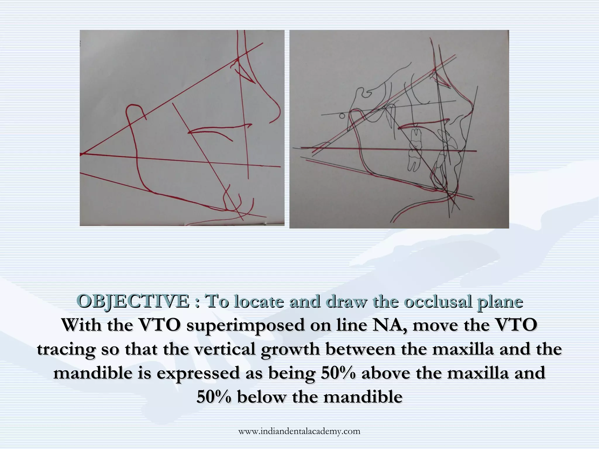 OBJECTIVE : To locate and draw the occlusal plane
With the VTO superimposed on line NA, move the VTO
tracing so that the vertical growth between the maxilla and the
mandible is expressed as being 50% above the maxilla and
50% below the mandible
www.indiandentalacademy.com

 