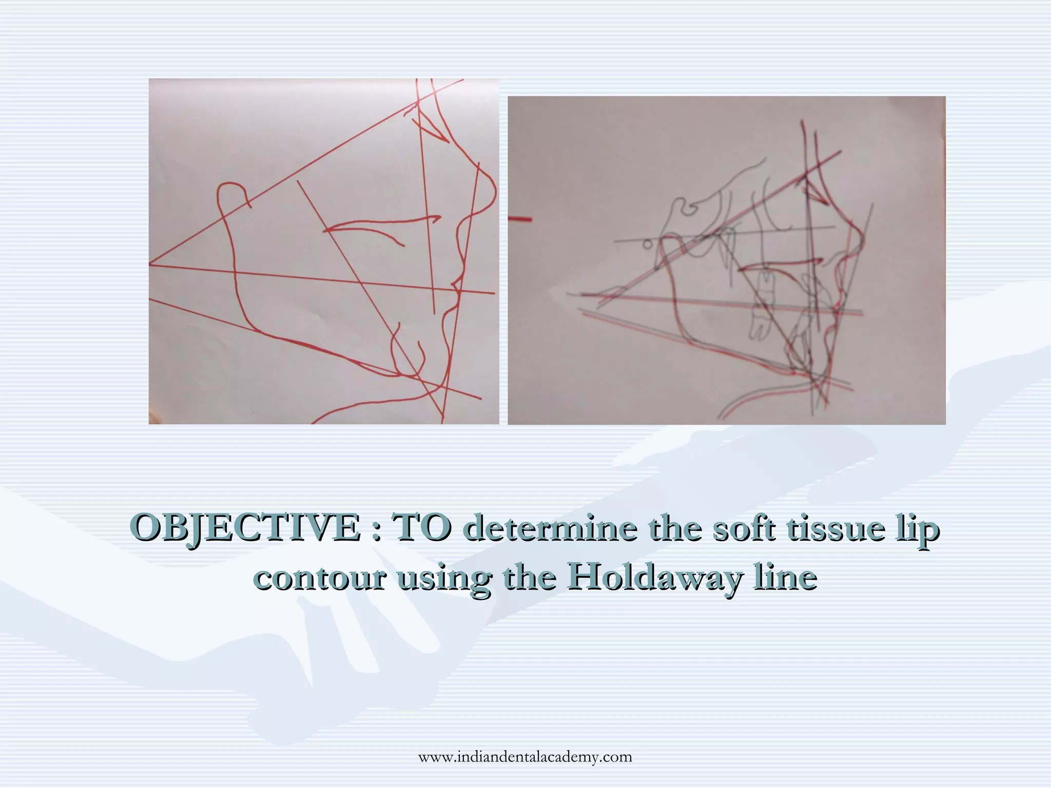OBJECTIVE : TO determine the soft tissue lip
contour using the Holdaway line

www.indiandentalacademy.com

 