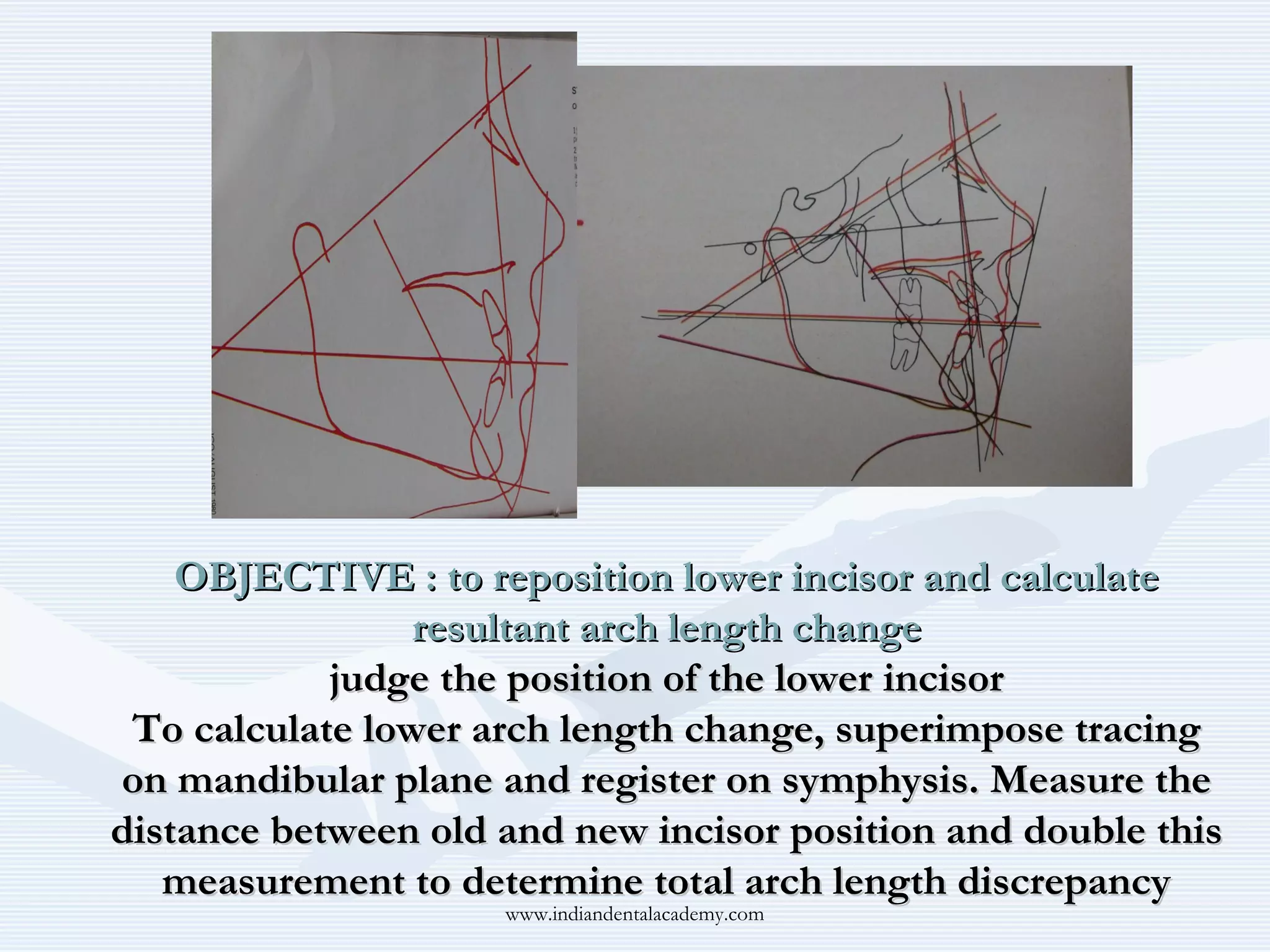 OBJECTIVE : to reposition lower incisor and calculate
resultant arch length change
judge the position of the lower incisor
To calculate lower arch length change, superimpose tracing
on mandibular plane and register on symphysis. Measure the
distance between old and new incisor position and double this
measurement to determine total arch length discrepancy
www.indiandentalacademy.com

 