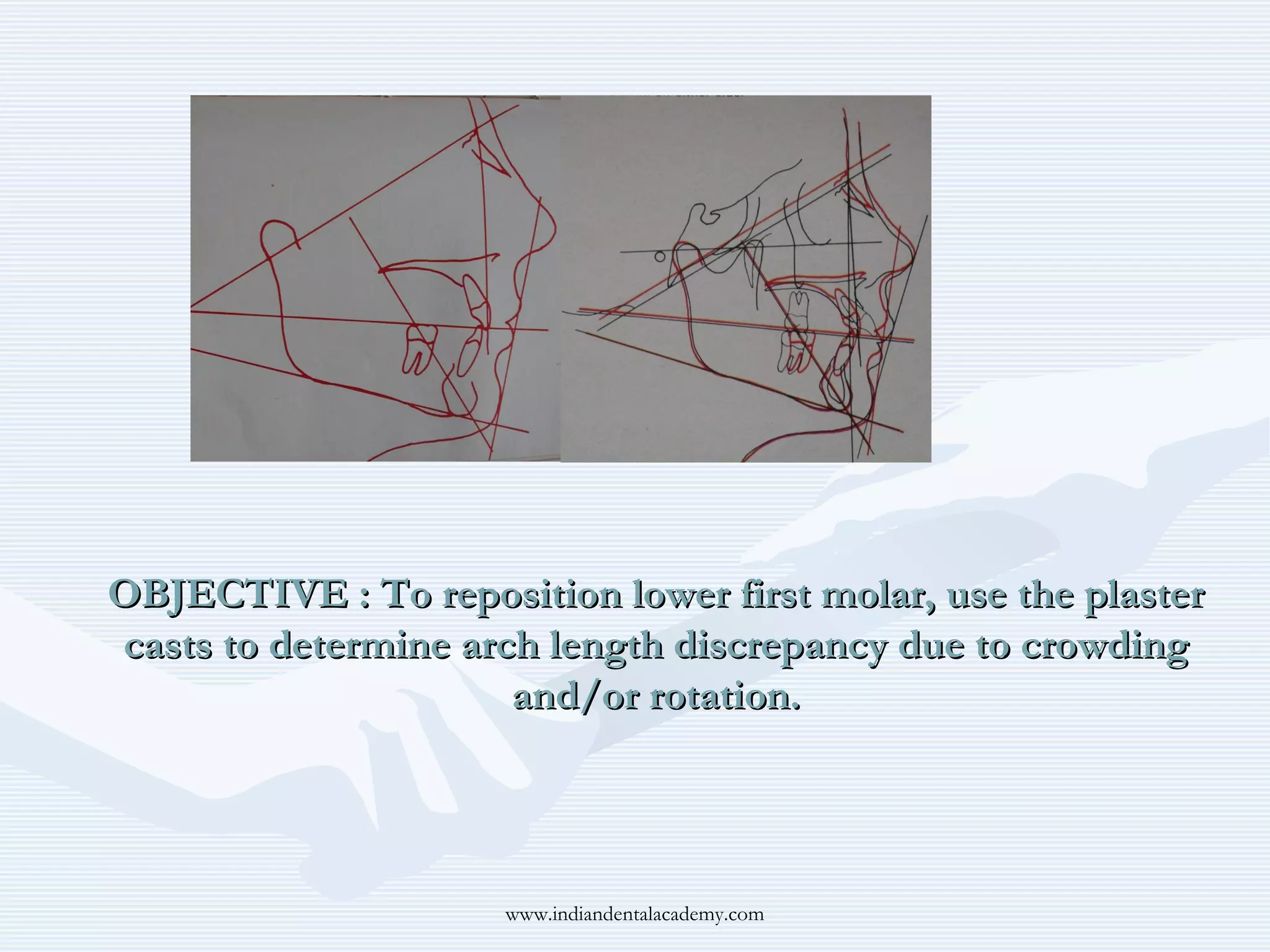 OBJECTIVE : To reposition lower first molar, use the plaster
casts to determine arch length discrepancy due to crowding
and/or rotation.

www.indiandentalacademy.com

 
