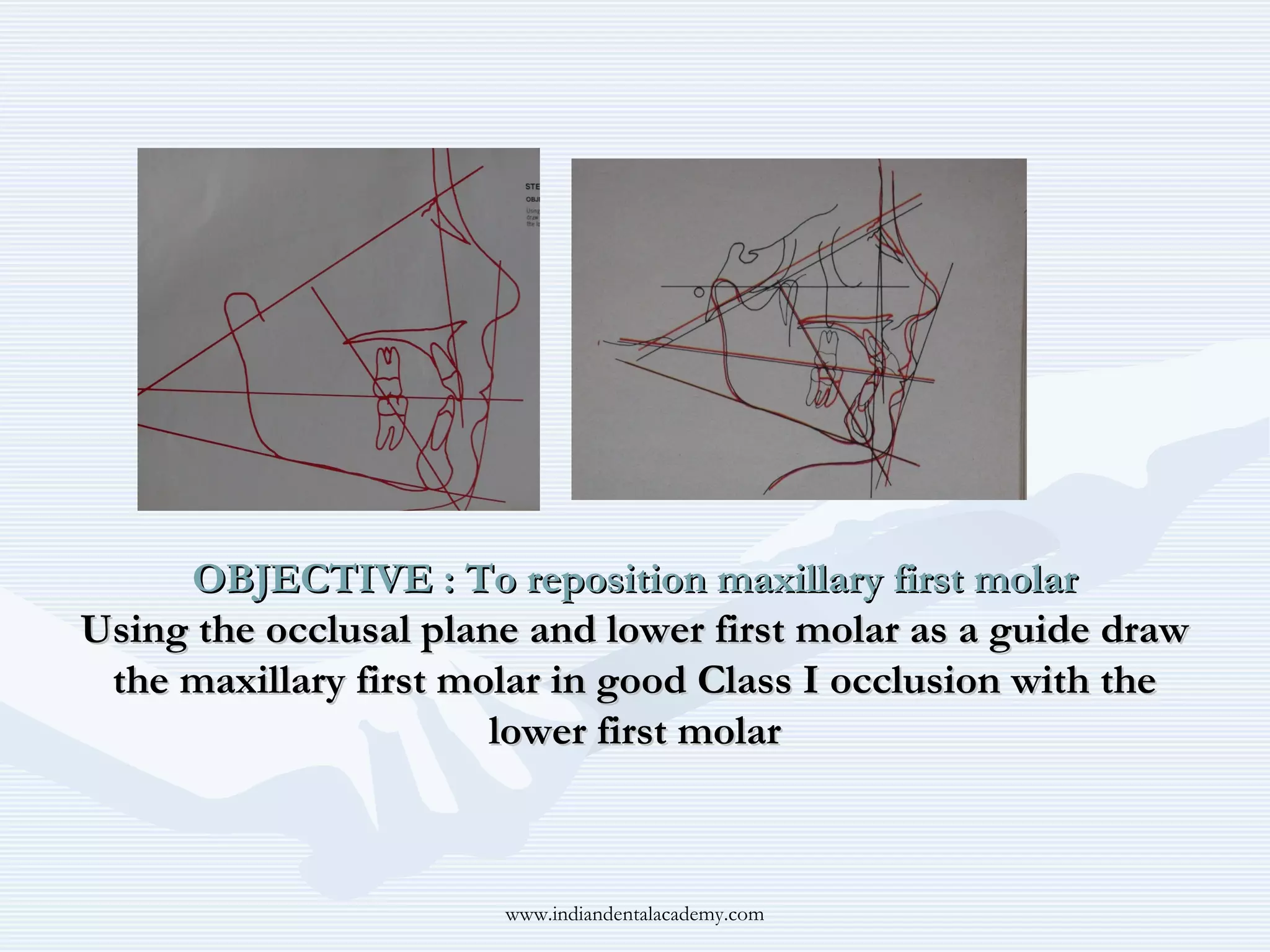 OBJECTIVE : To reposition maxillary first molar
Using the occlusal plane and lower first molar as a guide draw
the maxillary first molar in good Class I occlusion with the
lower first molar

www.indiandentalacademy.com

 