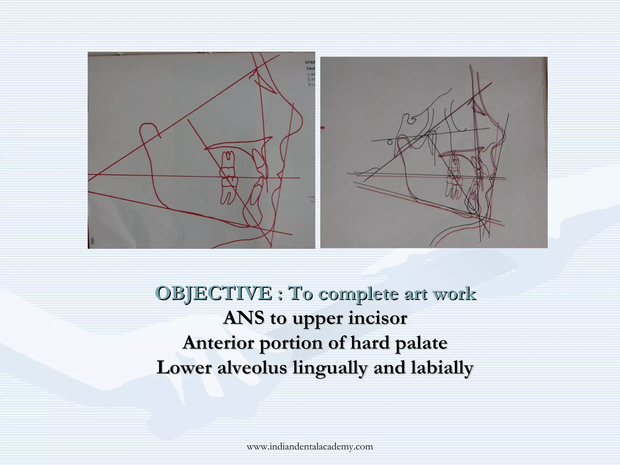 OBJECTIVE : To complete art work
ANS to upper incisor
Anterior portion of hard palate
Lower alveolus lingually and labially

www.indiandentalacademy.com

 