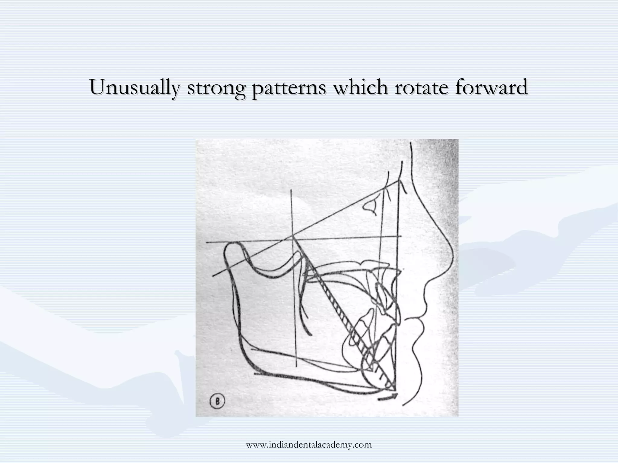 Unusually strong patterns which rotate forward

www.indiandentalacademy.com

 