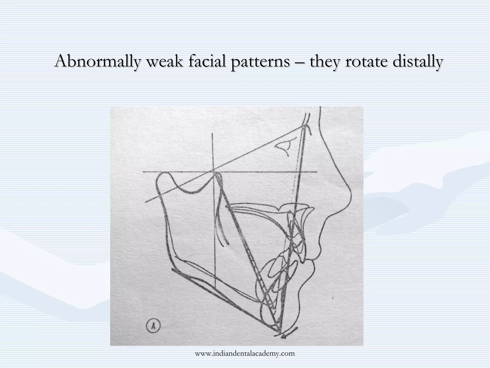 Abnormally weak facial patterns – they rotate distally

www.indiandentalacademy.com

 