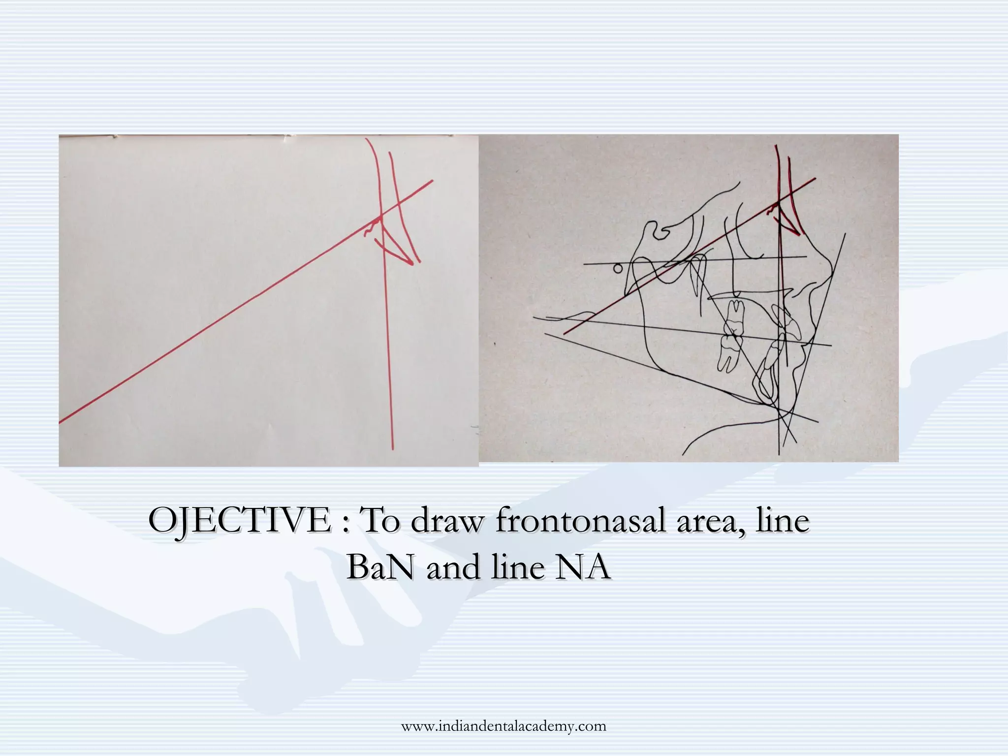 OJECTIVE : To draw frontonasal area, line
BaN and line NA

www.indiandentalacademy.com

 