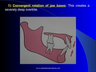 1) Convergent rotation of jaw bases: This creates a
severely deep overbite.
  
 
 
www.indiandentalacademy.com
 