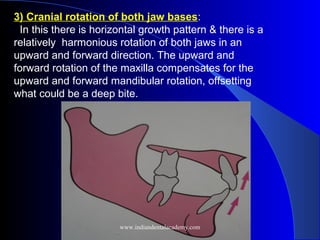 3) Cranial rotation of both jaw bases:
In this there is horizontal growth pattern & there is a
relatively harmonious rotation of both jaws in an
upward and forward direction. The upward and
forward rotation of the maxilla compensates for the
upward and forward mandibular rotation, offsetting
what could be a deep bite.
www.indiandentalacademy.com
 
