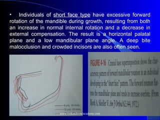  
• Individuals of short face type have excessive forward
rotation of the mandible during growth, resulting from both
an increase in normal internal rotation and a decrease in
external compensation. The result is a horizontal palatal
plane and a low mandibular plane angle. A deep bite
malocclusion and crowded incisors are also often seen.
 
www.indiandentalacademy.com
 