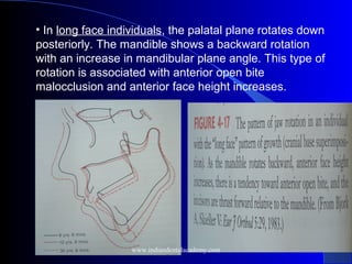 • In long face individuals, the palatal plane rotates down
posteriorly. The mandible shows a backward rotation
with an increase in mandibular plane angle. This type of
rotation is associated with anterior open bite
malocclusion and anterior face height increases.
www.indiandentalacademy.com
 