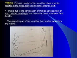 TYPE II: Forward rotation of the mandible about a center
located at the incise edges of the lower anterior teeth.
• This is due to the combination of marked development of
the posterior face height and normal increase in anterior face
height.
• The posterior part of the mandible then rotated away from
the maxilla.
www.indiandentalacademy.com
 