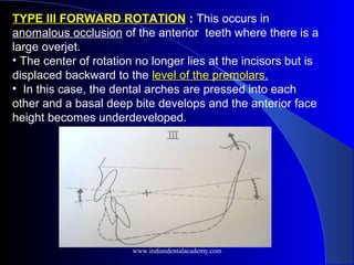 TYPE III FORWARD ROTATION : This occurs in
anomalous occlusion of the anterior teeth where there is a
large overjet.
• The center of rotation no longer lies at the incisors but is
displaced backward to the level of the premolars.
• In this case, the dental arches are pressed into each
other and a basal deep bite develops and the anterior face
height becomes underdeveloped.
www.indiandentalacademy.com
 