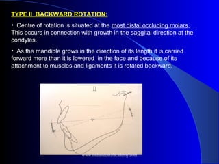 TYPE II BACKWARD ROTATION:
• Centre of rotation is situated at the most distal occluding molars,
This occurs in connection with growth in the saggital direction at the
condyles.
• As the mandible grows in the direction of its length it is carried
forward more than it is lowered in the face and because of its
attachment to muscles and ligaments it is rotated backward.
www.indiandentalacademy.com
 