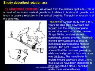 Shudy described rotation as:
1) Clockwise rotation: ( as viewed from the patients right side) This is
a result of excessive vertical growth as it relates to horizontal growth, and
tends to cause a reduction in the vertical overbite. The point of rotation is at
the condyles.
fig showes :Growth study from 6 to10
years the chin grew downward and
forward and the mandibular plane
moved downward in parallel manner.
At age 10 the condyles almost
completely ceased growing. Then chin
movied downward and backward,
mandibular plane became 7degree
steeper. The post. Growth analysis
showed that the condyles grew 4mm
while vertical growth in the molar area
was 10.5mm . The mandibular 1st
molars moved backward about 3mm;
thus it would have been impossible to
have corrected a class II condition
under these circumstances.
www.indiandentalacademy.com
 