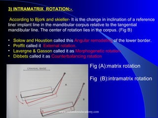 3) INTRAMATRIX ROTATION:-
According to Bjork and skieller- It is the change in inclination of a reference
line/ implant line in the mandibular corpus relative to the tangential
mandibular line. The center of rotation lies in the corpus. (Fig B)
• Solow and Houstion called this Angular remodeling of the lower border.
• Proffit called it External rotation.
• Lavergne & Gasson called it as Morphogenetic rotation.
• Dibbets called it as Counterbalancing rotation
Fig (A):matrix rotation
Fig (B):intramatrix rotation
www.indiandentalacademy.com
 