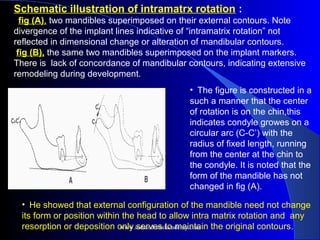 Schematic illustration of intramatrx rotation :
fig (A), two mandibles superimposed on their external contours. Note
divergence of the implant lines indicative of “intramatrix rotation” not
reflected in dimensional change or alteration of mandibular contours.
fig (B), the same two mandibles superimposed on the implant markers.
There is lack of concordance of mandibular contours, indicating extensive
remodeling during development.
• The figure is constructed in a
such a manner that the center
of rotation is on the chin,this
indicates condyle growes on a
circular arc (C-C’) with the
radius of fixed length, running
from the center at the chin to
the condyle. It is noted that the
form of the mandible has not
changed in fig (A).
• He showed that external configuration of the mandible need not change
its form or position within the head to allow intra matrix rotation and any
resorption or deposition only serves to maintain the original contours.
www.indiandentalacademy.com
 
