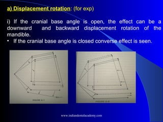 a) Displacement rotation: (for exp)
i) If the cranial base angle is open, the effect can be a
downward and backward displacement rotation of the
mandible.
• If the cranial base angle is closed converse effect is seen.
www.indiandentalacademy.com
 
