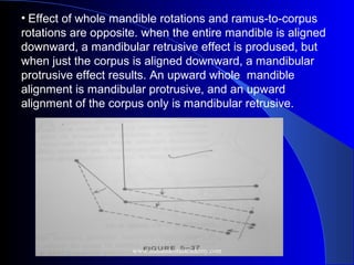• Effect of whole mandible rotations and ramus-to-corpus
rotations are opposite. when the entire mandible is aligned
downward, a mandibular retrusive effect is prodused, but
when just the corpus is aligned downward, a mandibular
protrusive effect results. An upward whole mandible
alignment is mandibular protrusive, and an upward
alignment of the corpus only is mandibular retrusive.
www.indiandentalacademy.com
 