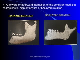 1) A forward or backward inclination of the condylar head is a
characteristic sign of forward or backward rotation 
 
FORWARD ROTATION BACKWARD ROTATION
www.indiandentalacademy.com
 